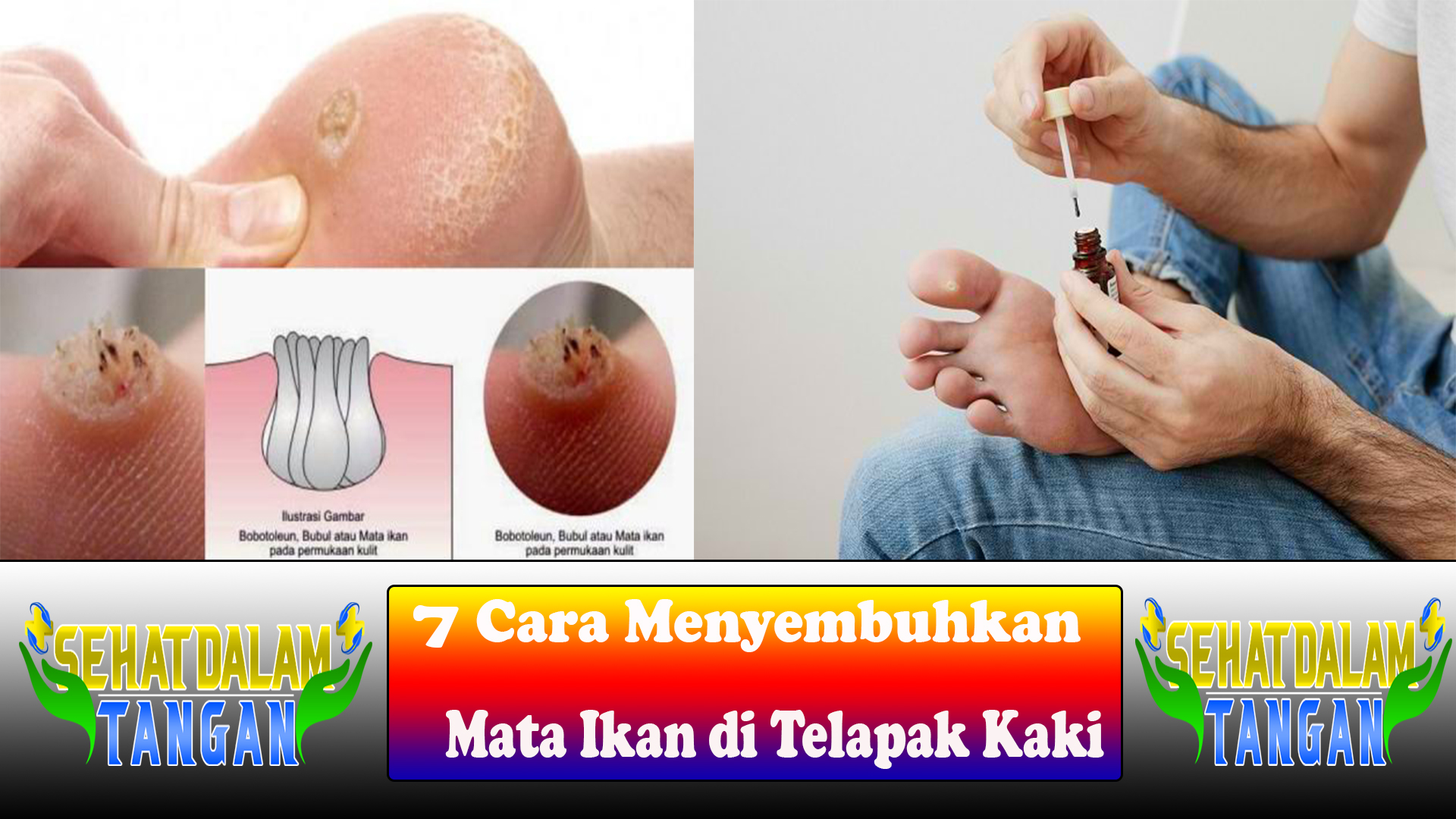 7 Cara Menyembuhkan Mata Ikan di Telapak Kaki