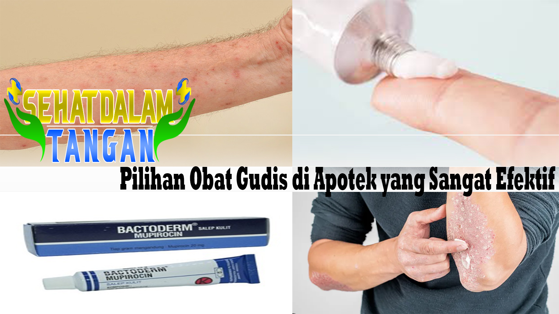 Pilihan Obat Gudik di Apotek yang Sangat Efektif