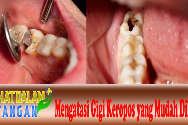 Mengatasi Gigi Keropos yang Mudah Dilakukan