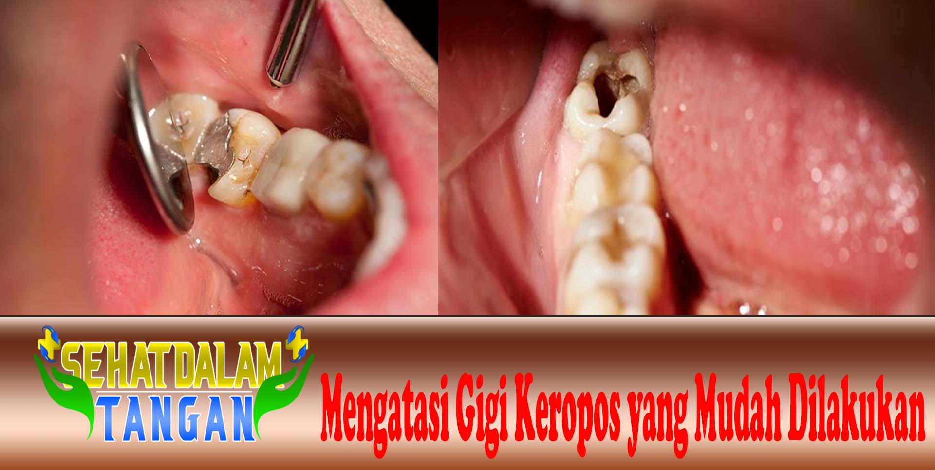 Mengatasi Gigi Keropos yang Mudah Dilakukan