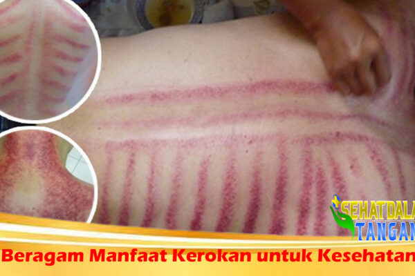 Beragam Manfaat Kerokan untuk Kesehatan