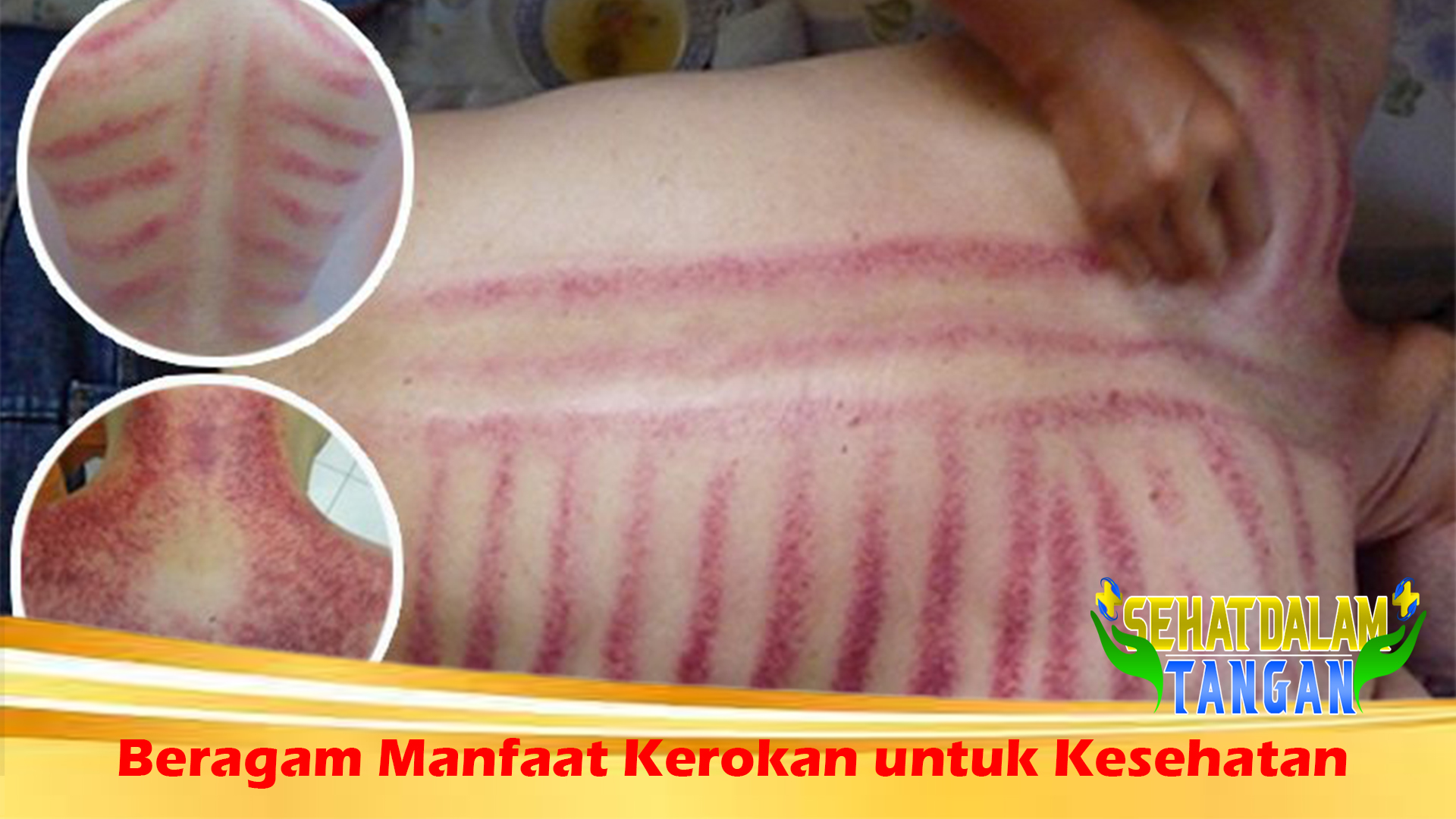 Beragam Manfaat Kerokan untuk Kesehatan