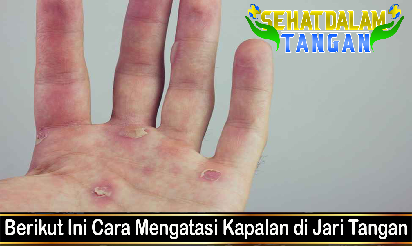 Berikut Ini Cara Mengatasi Kapalan di Jari Tangan