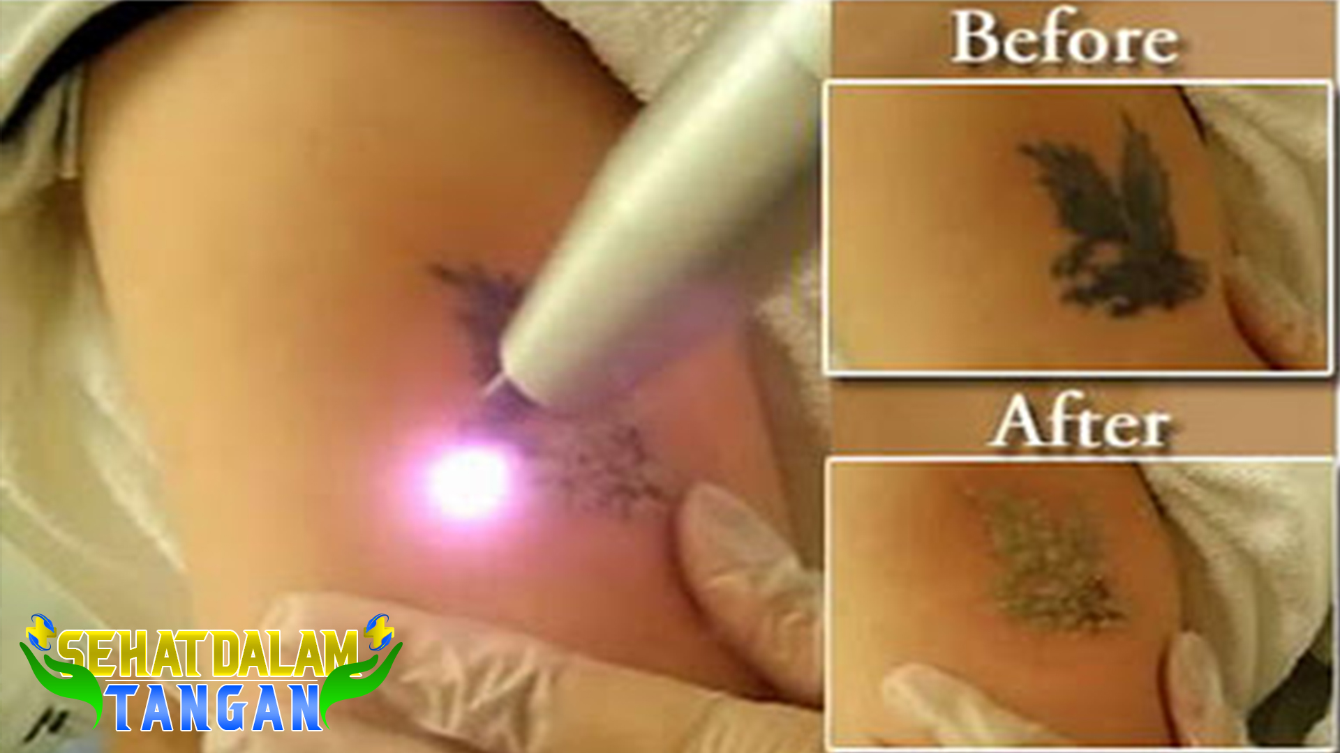 Efek Menghilangkan Tato dengan Laser
