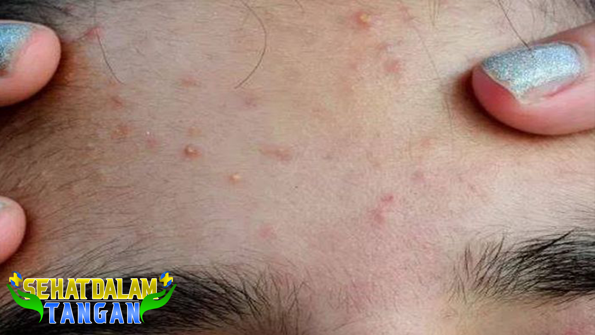 7 Cara Menghilangkan Bruntusan di Jidat secara Alami