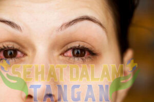 Mata Kering dan Lelah? Ini Solusi Biar Nggak Gampang Sayu