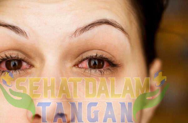 Mata Kering dan Lelah? Ini Solusi Biar Nggak Gampang Sayu Mata Kering dan Lelah? Ini Solusi Biar Nggak Gampang Sayu