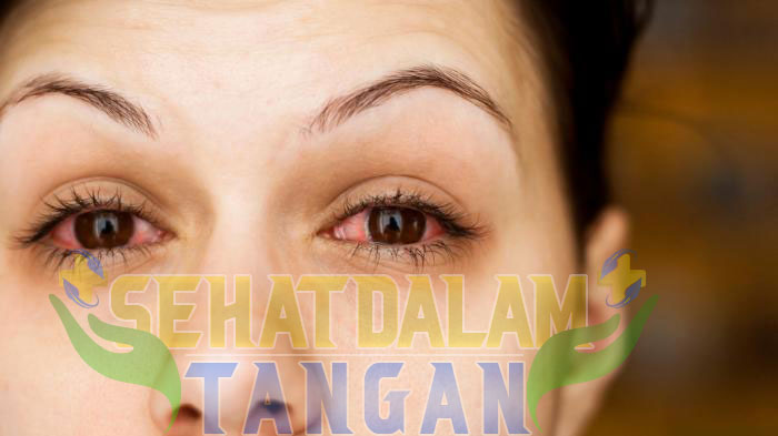 Mata Kering dan Lelah? Ini Solusi Biar Nggak Gampang Sayu